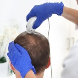 Introlift-Hair-Loss-Treatments-for-Men-Treatment